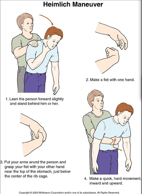 How to do the Heimlich Maneuver